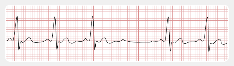 Second degree av block