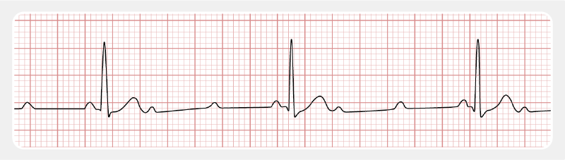 Third degree AV block