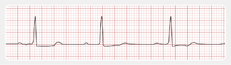First degree AV block