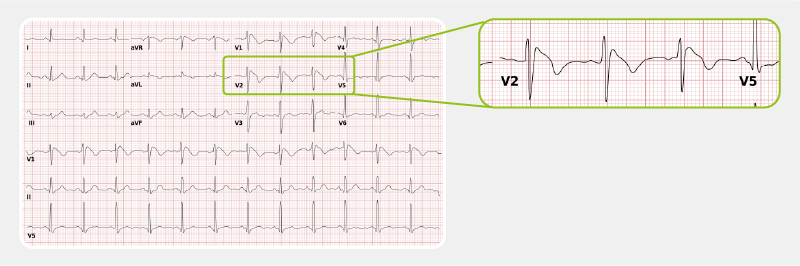 Brugada syndrome