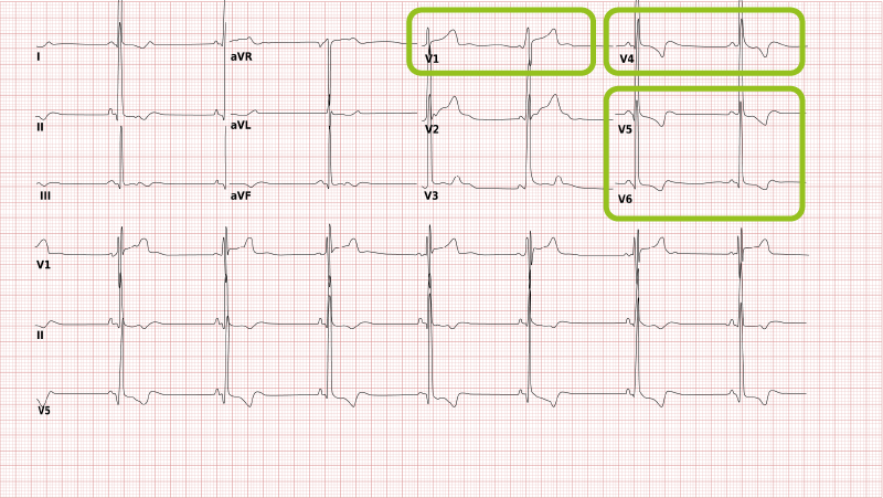 Left ventricular hypertrophy