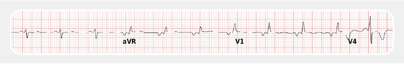 Right ventricular hypertrophy