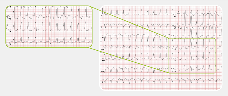 Ventricular Tachycardia