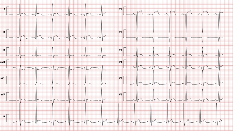 Myocarditis