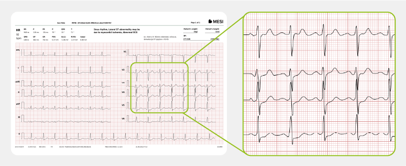 NSTEMI myocardial infarction
