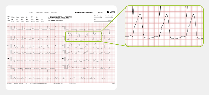 STEMI myocardial infarction