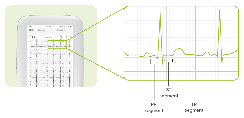 ECG-Segments