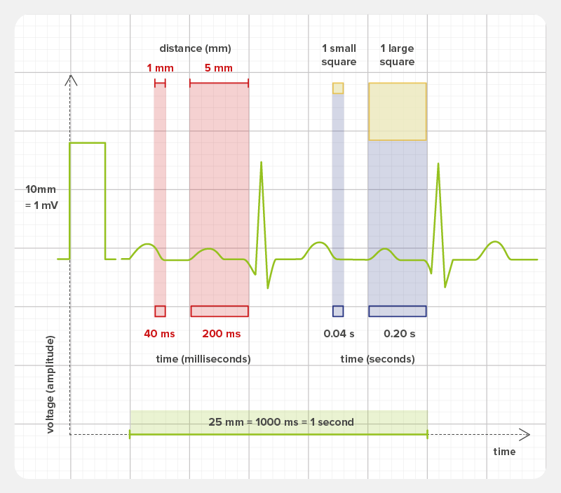 Distances-on-ECG-paper-or-graph