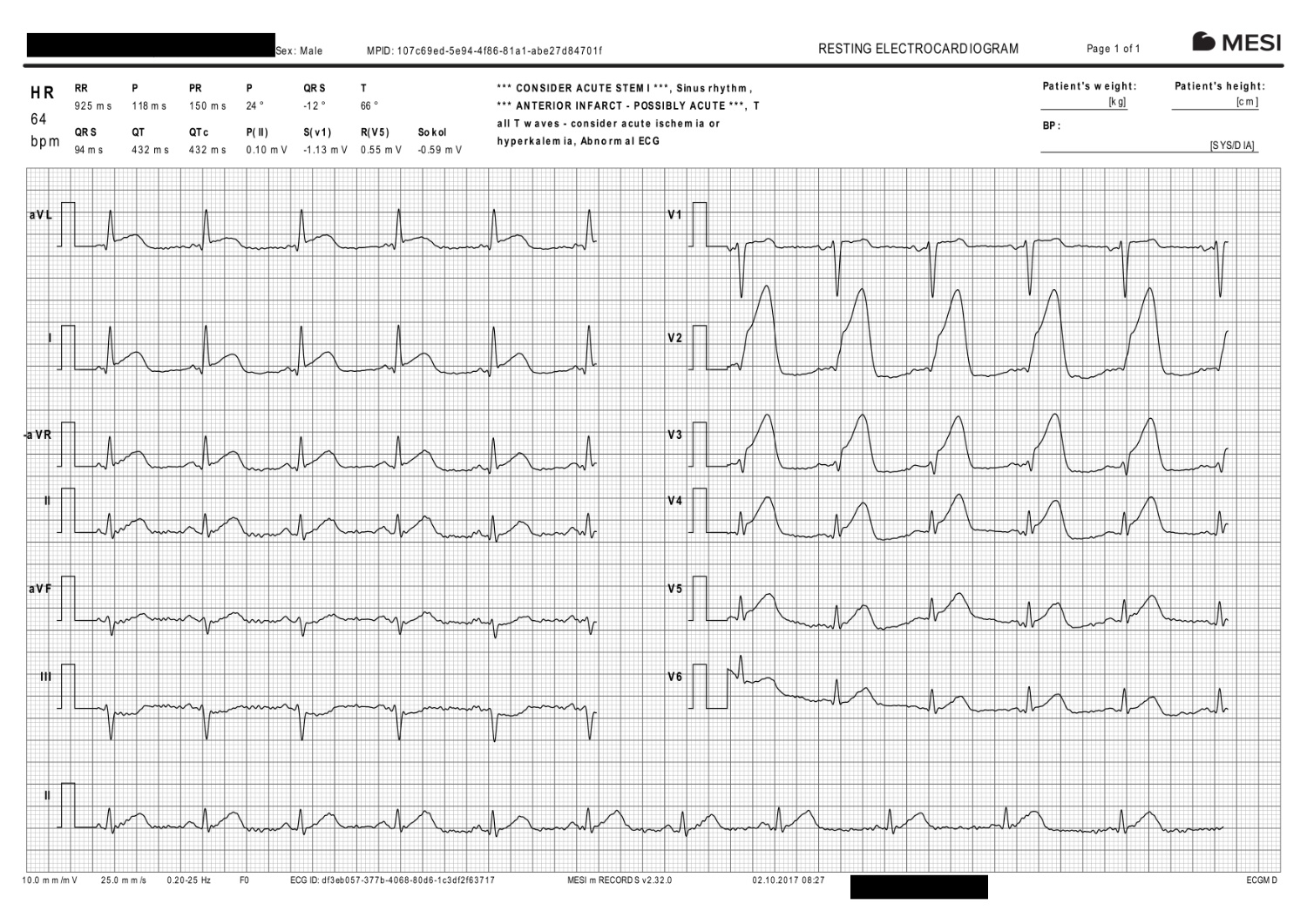 evident heart attack (STEMI)