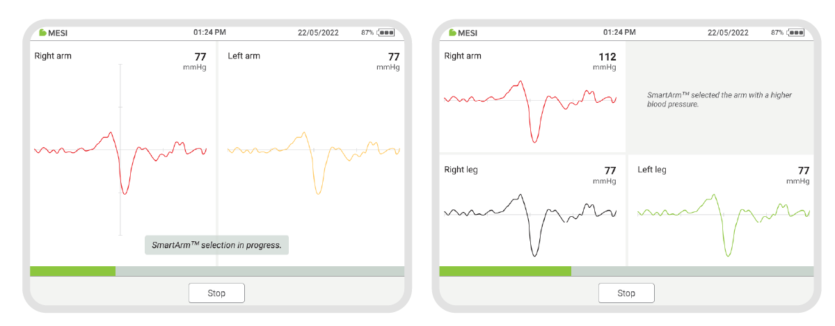 MESI-ABPI-MD-–-Screen-during-2-step-measurement