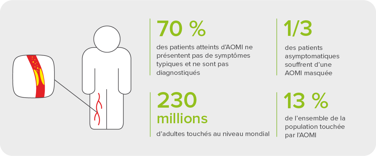 L’artériopathie oblitérante des membres inférieurs (AOMI), une maladie sous-diagnostiquée