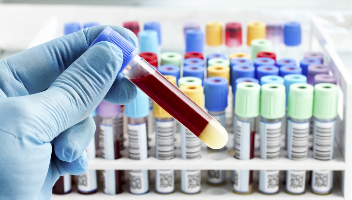 (PAPP)-A in sera from type 2 diabetic patients with hypercholesterolemia