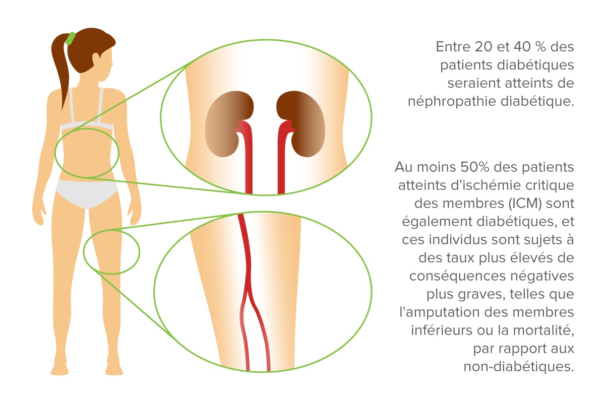 Indice de pression systolique ou indice de pression à l’orteil en néphrologie