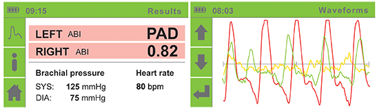 STEP 2: Perform an Ankle-Brachial Index (ABI) measurement