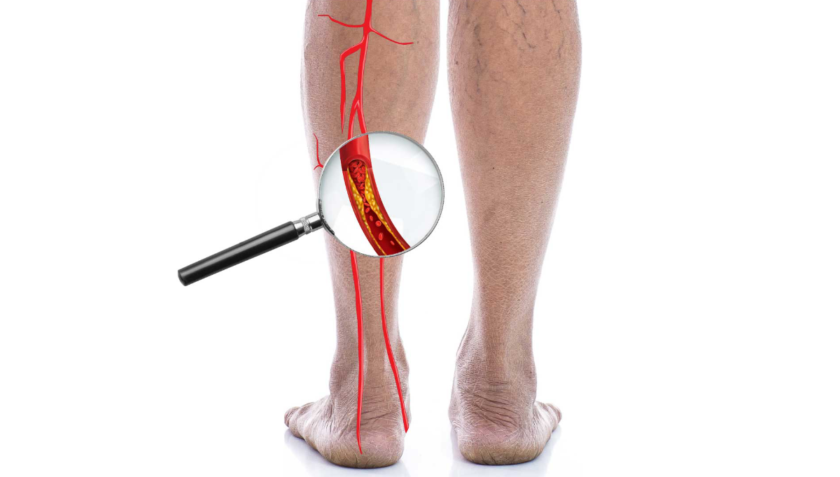 Peripheral-arterial-disease-and-diabetes