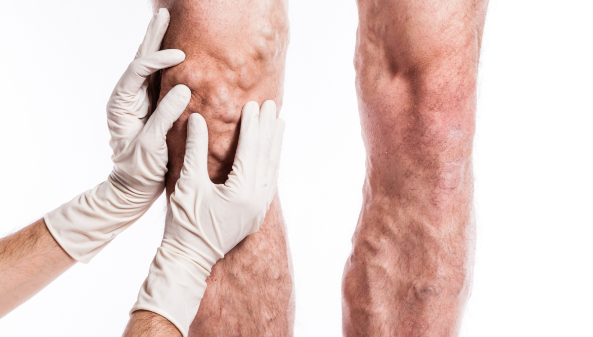 Importance-of-early-diagnosis-for-PAD-prevention