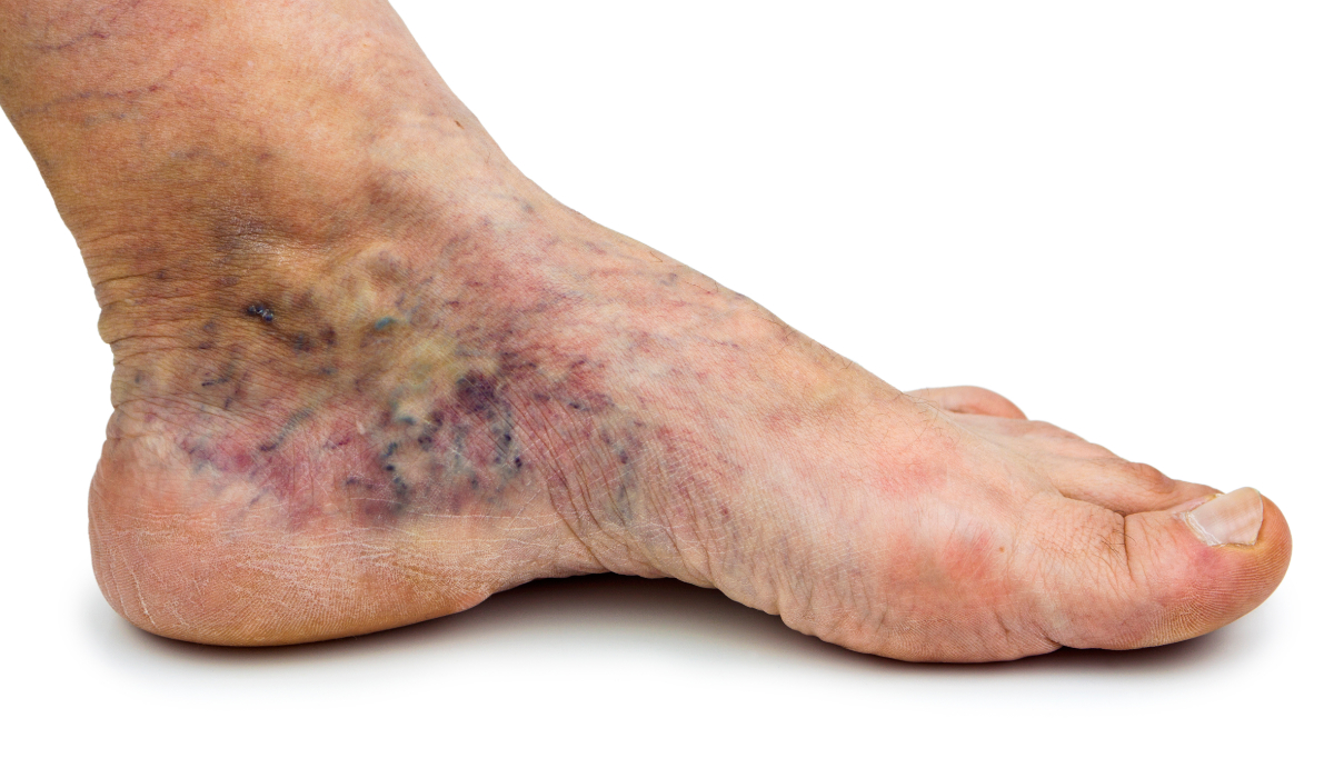 The impact of other factors on the treatment of Peripheral Arterial Disease (PAD)