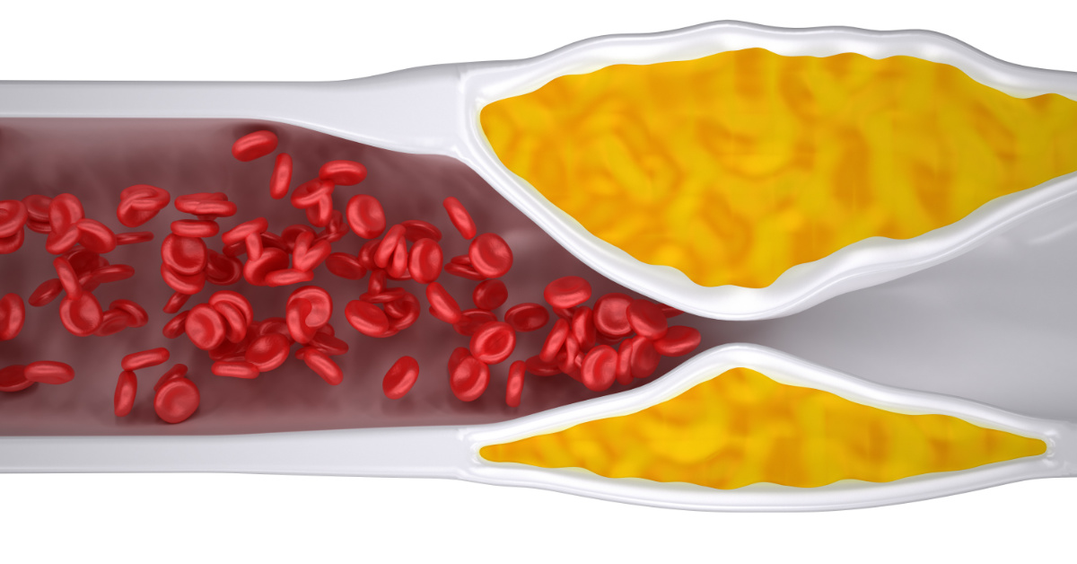 what-is-peripheral-arterial-disease-pad-4