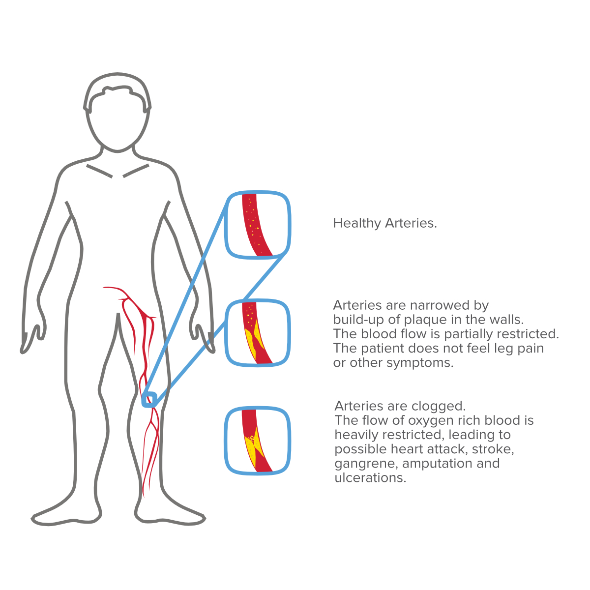what-is-peripheral-arterial-disease-pad