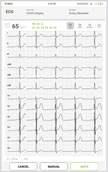 MESI mTABLET ECG - Recording the ecg - Step 10