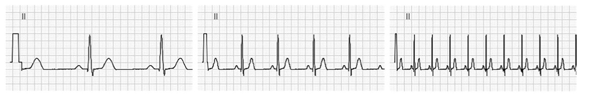 MESI mTABLET ECG - Recording the ecg - Recording speed