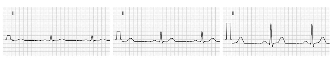 MESI mTABLET ECG - Recording the ecg - Sensitivity