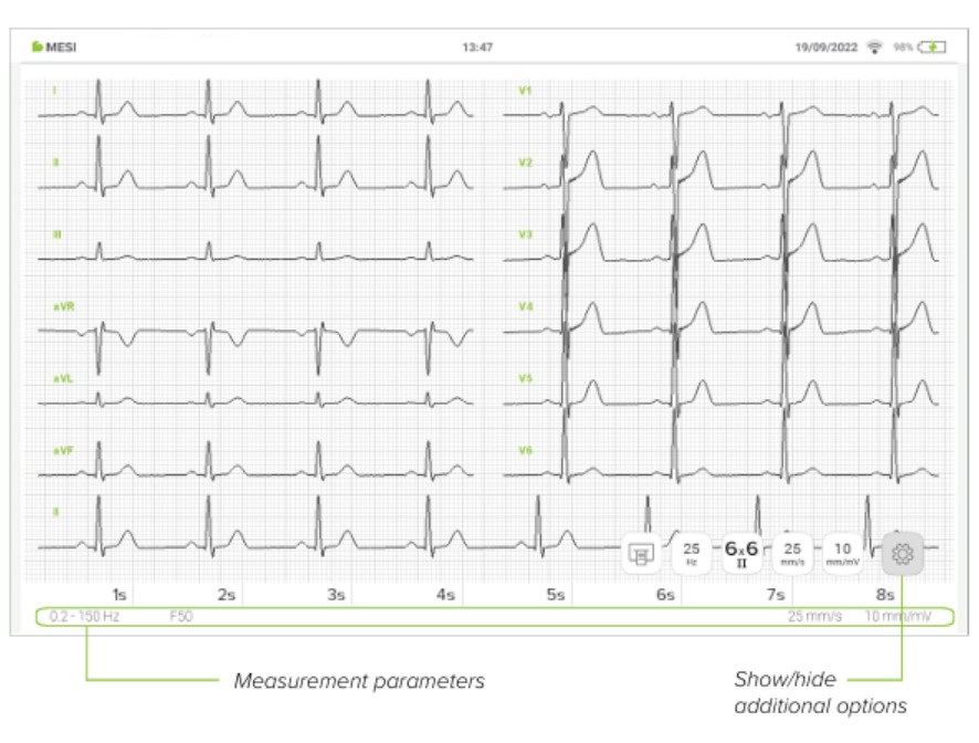 MESI mTABLET ECG - Reviewing ECG (2)