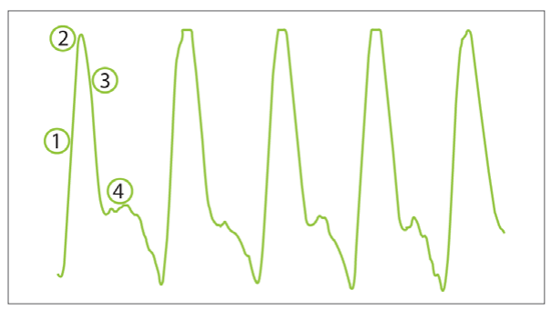 ABPI MD pulse waveforms