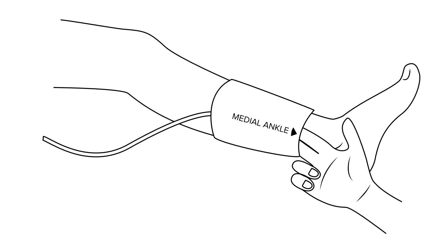 ABPI MD cuff placement