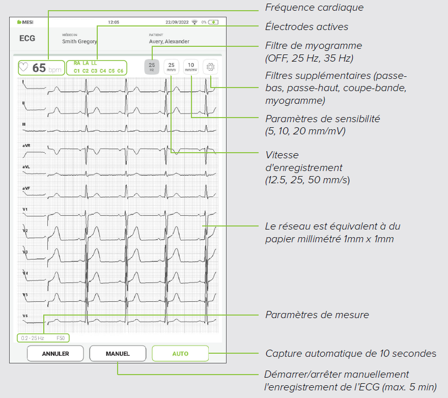 MESI mTABLET ECG - Recording the ecg - Step 7