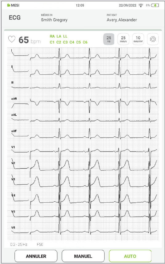 MESI mTABLET ECG - Recording the ecg - Step 10