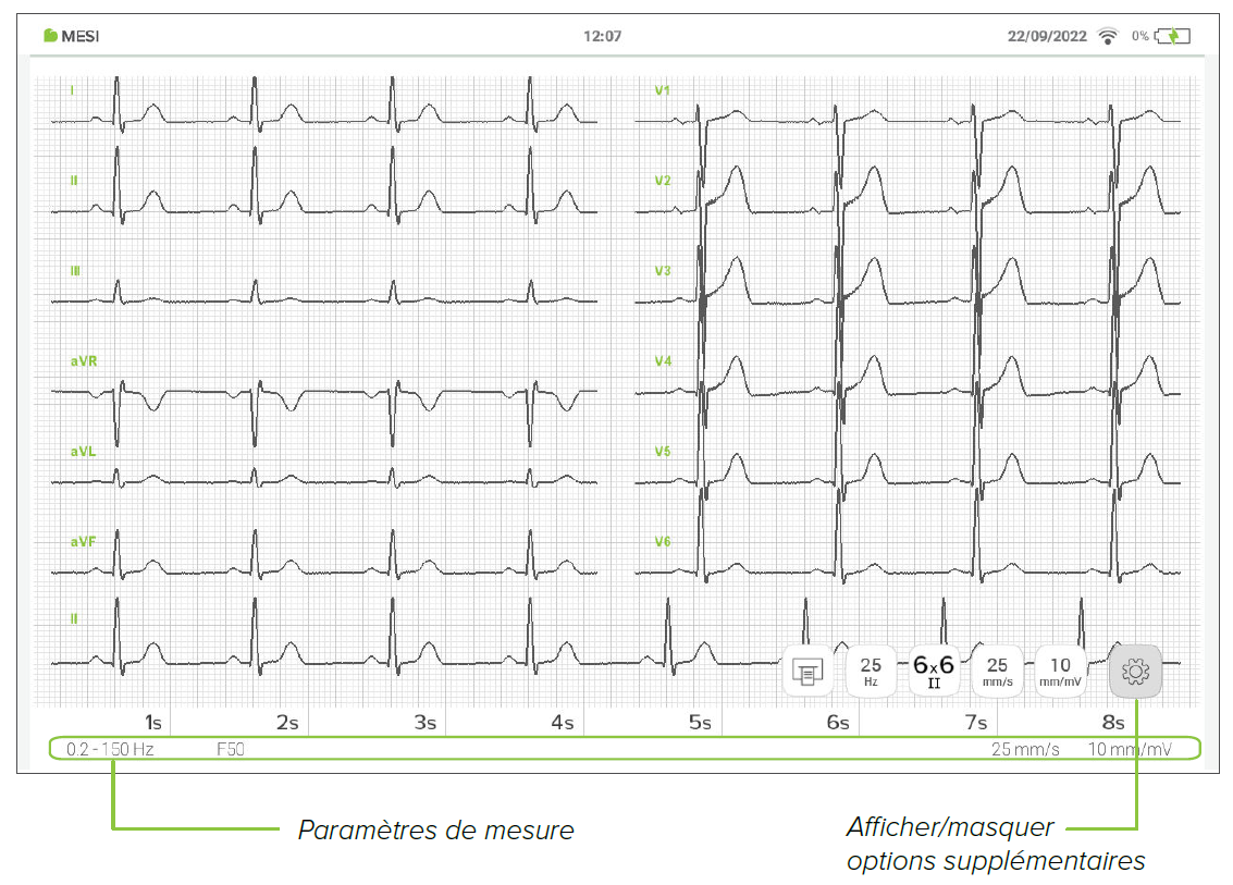 MESI mTABLET ECG - Reviewing ECG (2)