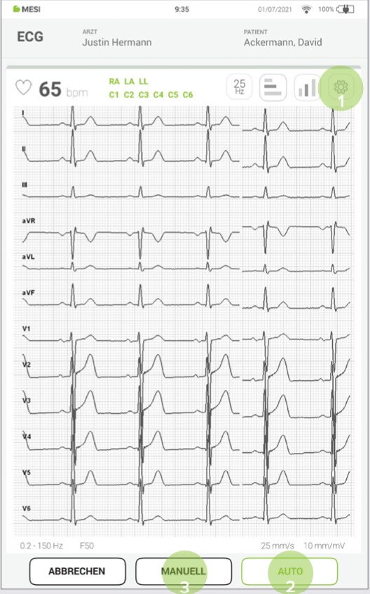 MESI mTABLET ECG-DURCHFÜHRUNG DER EKGAUFZEICHNUNG - Schritt 4