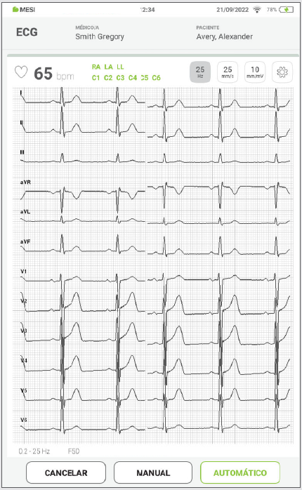 MESI mTABLET ECG - Recording the ecg - Step 10