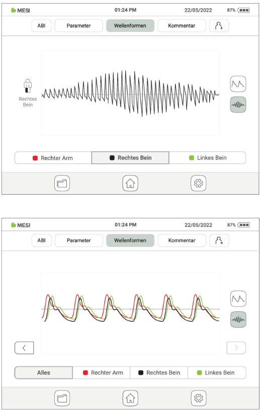 MESI ABPI MD V2 - Wellenformen