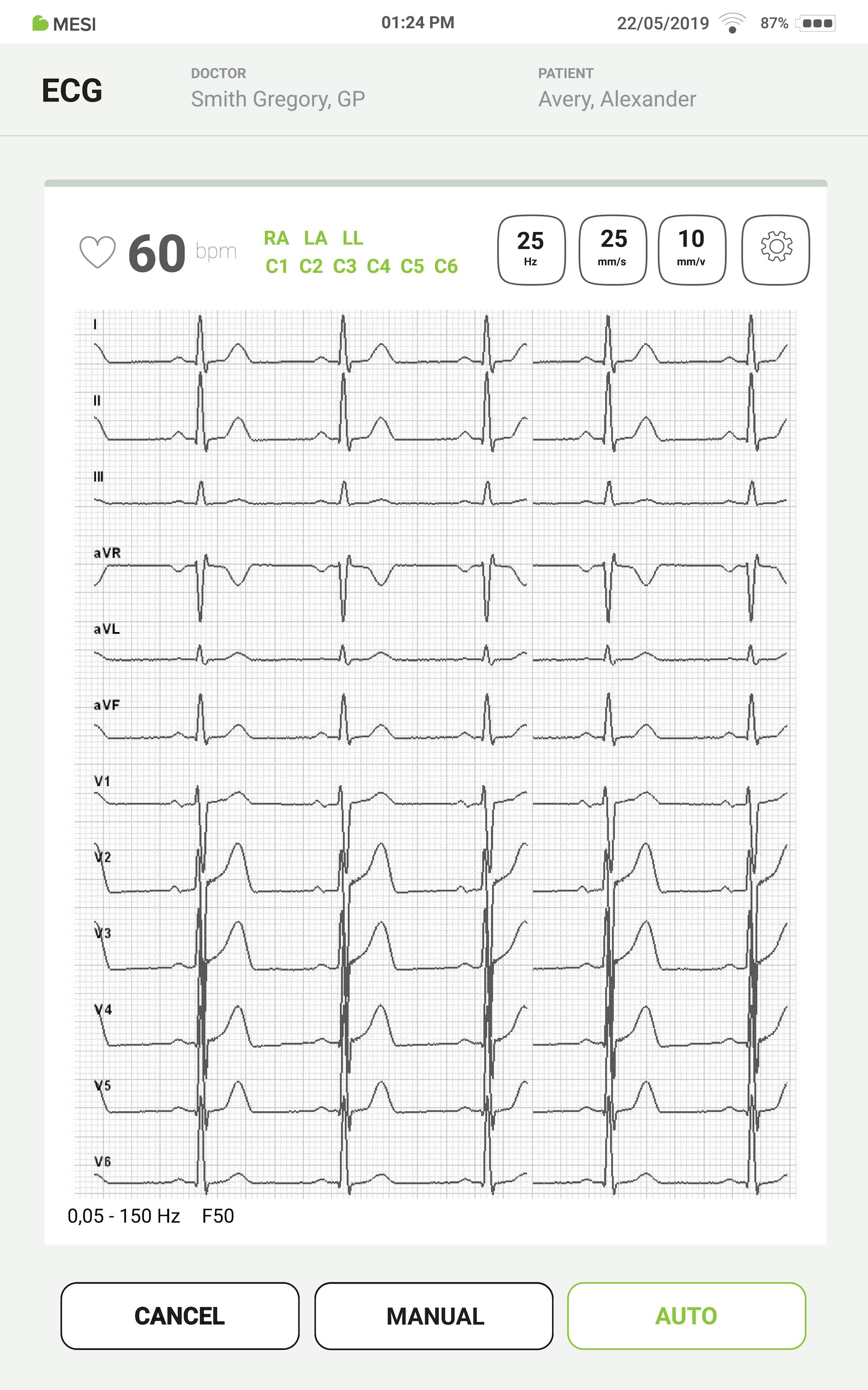 ECG Screen