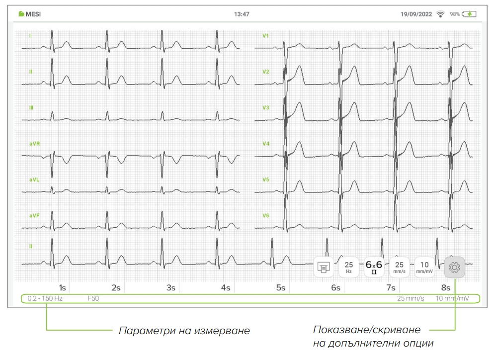 BG ECG reading
