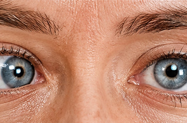 Esotropia