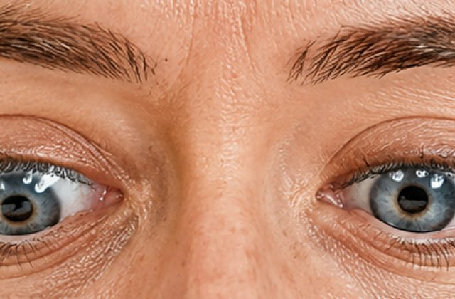 Hypotropia