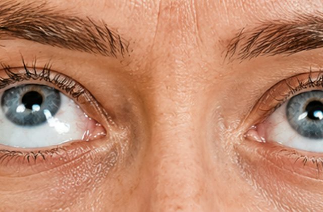 Hypotropia