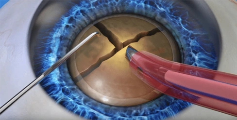 Traditional cataract surgery using a blade