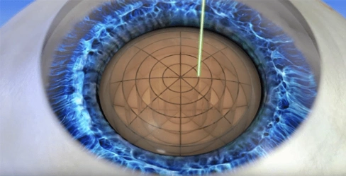 Laser assisted cataract surgery