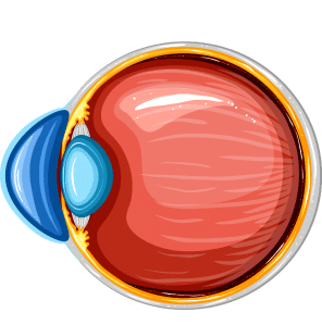 Keratoconus