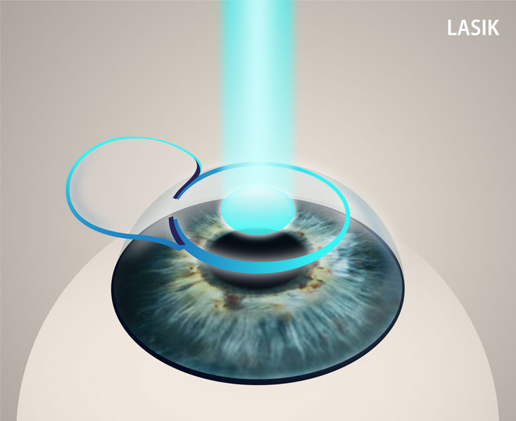 Photorefractive Keratectomy (PRK) infographic