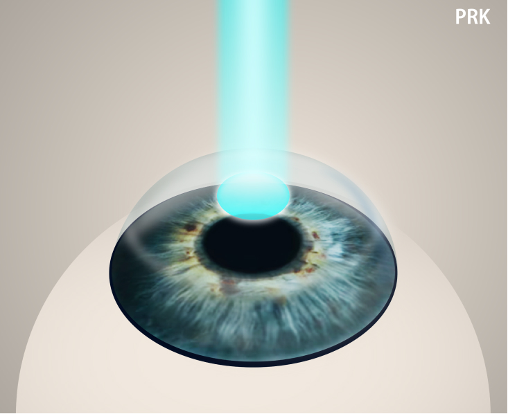 Photorefractive Keratectomy (PRK) infographic