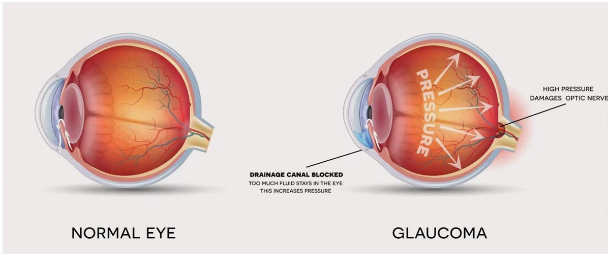 glaucoma infographic