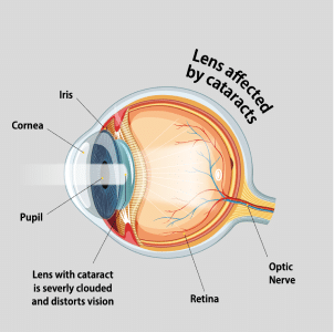 diabetic eye disease infographic