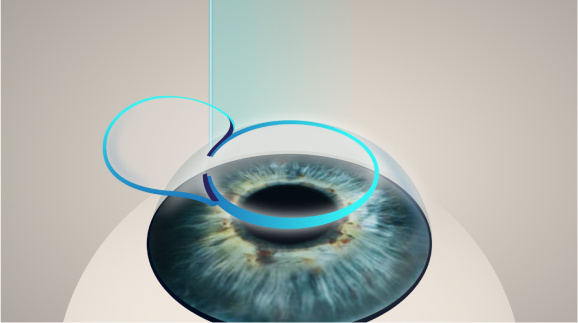 lasik steps infographic