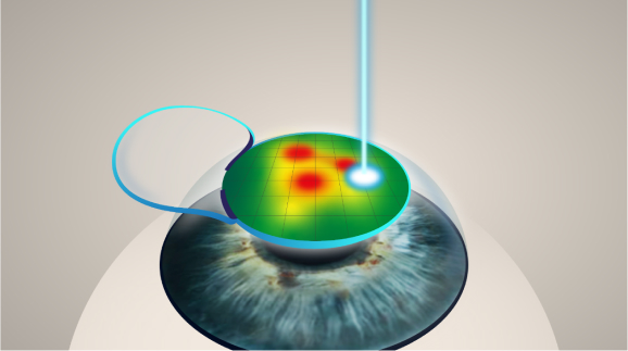 lasik steps infographic