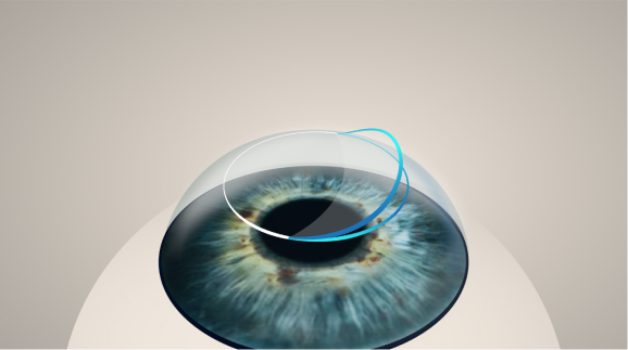 lasik steps infographic
